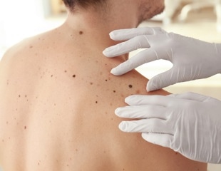 Advanced melanoma survival rates improve significantly from 2013 to 2019, Dutch study finds