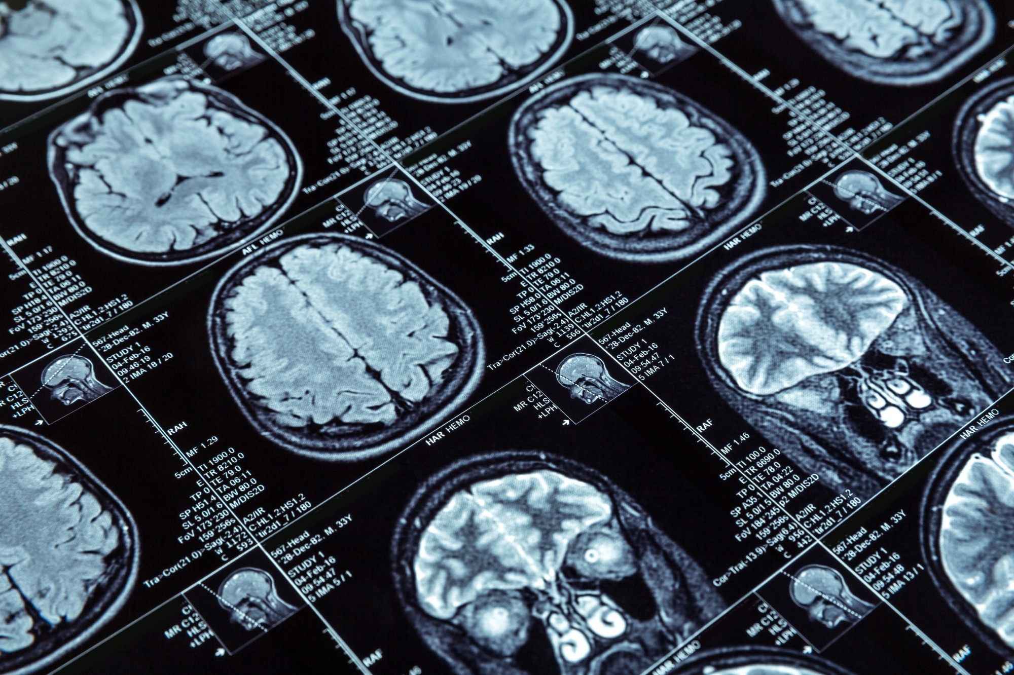 Study: Using brain structural neuroimaging measures to predict psychosis onset for individuals at clinical high-risk. Image Credit: Nomad_Soul/Shutterstock.com