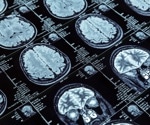 New machine learning model uses MRI scans to predict psychosis onset