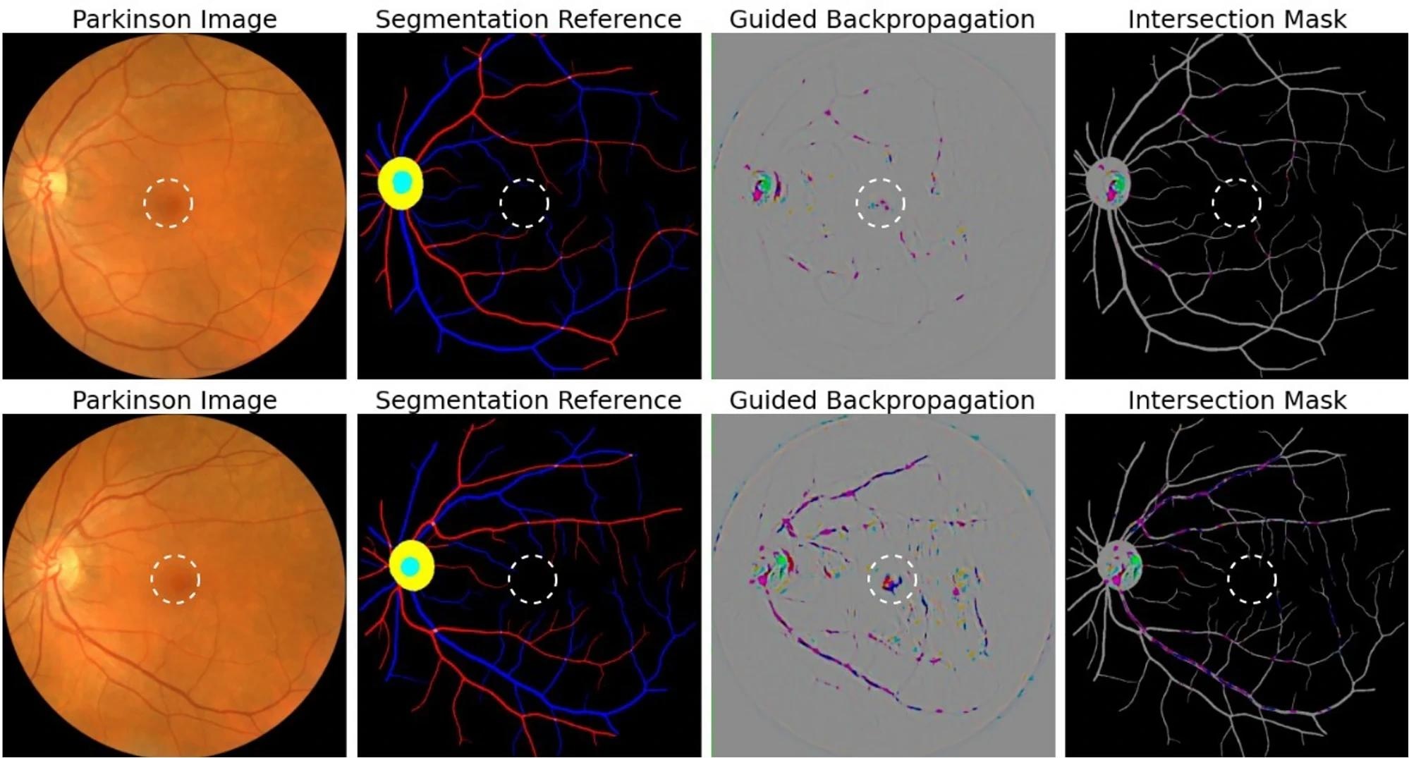 Attribution correspondence of retinal features. In the first column, an artery-vein (red and blue, respectively) map is combined with the optic cup (teal) and optic disc (yellow) generated from the AutoMorph deep learning segmentation module. A white dashed line is shown as an estimate for the foveal region. In the third column, a predicted attribution map is generated using the guided backpropagation algorithm on top of the AlexNet model. The intersection of the salient features with the segmentation is shown in the last column. The images represent the left (top) and right (bottom) eyes from the same subject, demonstrating distinct feature distributions for prediction.