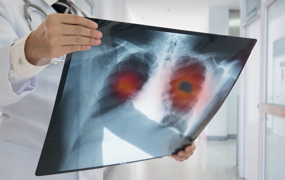Study: AI-based pipeline for early screening of lung cancer: integrating radiology, clinical, and genomics data. Image Credit: create jobs 51/Shutterstock.com