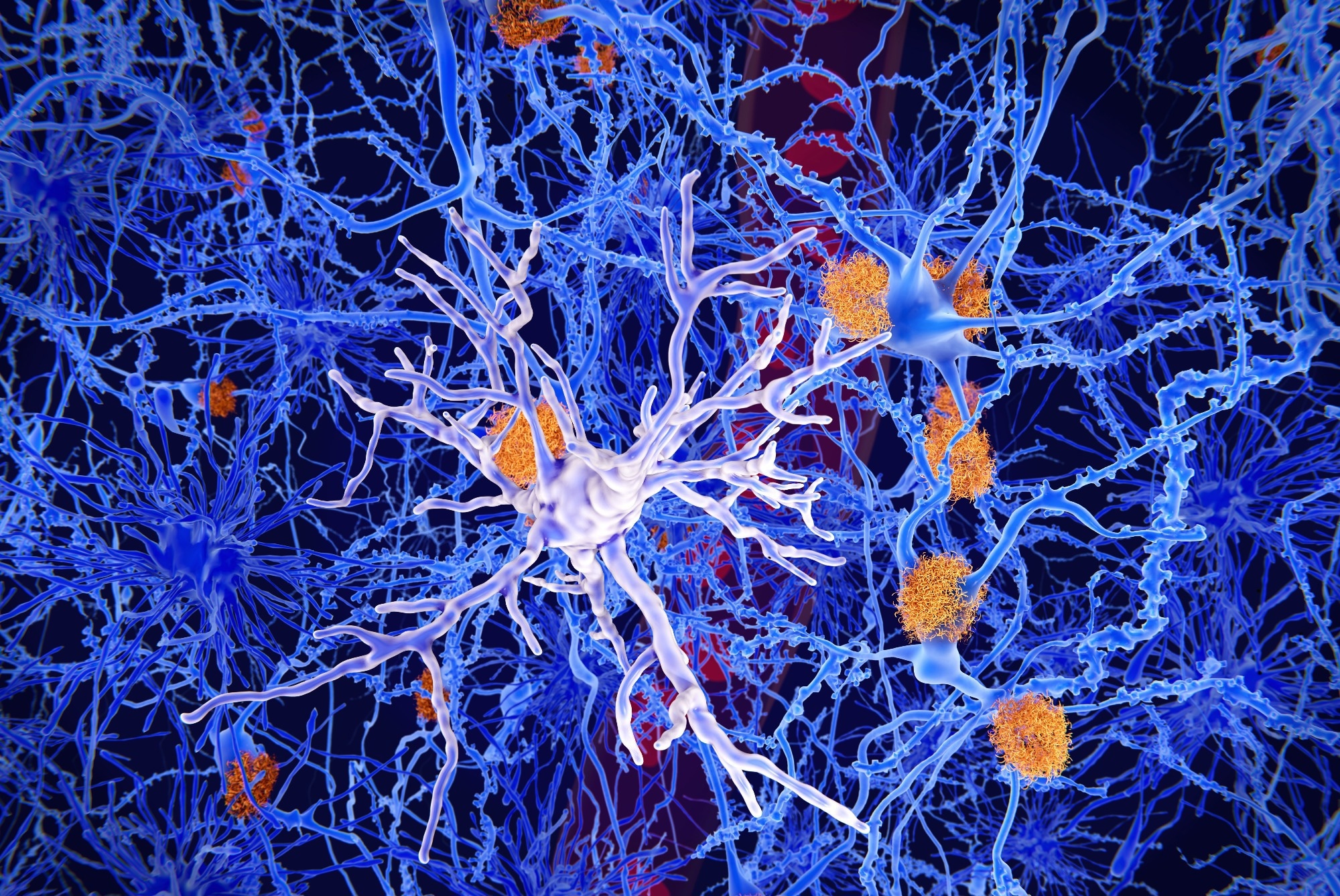 Study: Highly Accurate Blood Test for Alzheimer’s Disease Comparable or Superior to Clinical CSF Tests. Image Credit: Juan Gaertner / Shutterstock