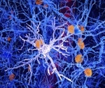 Blood test rivals spinal fluid analysis in Alzheimer's detection