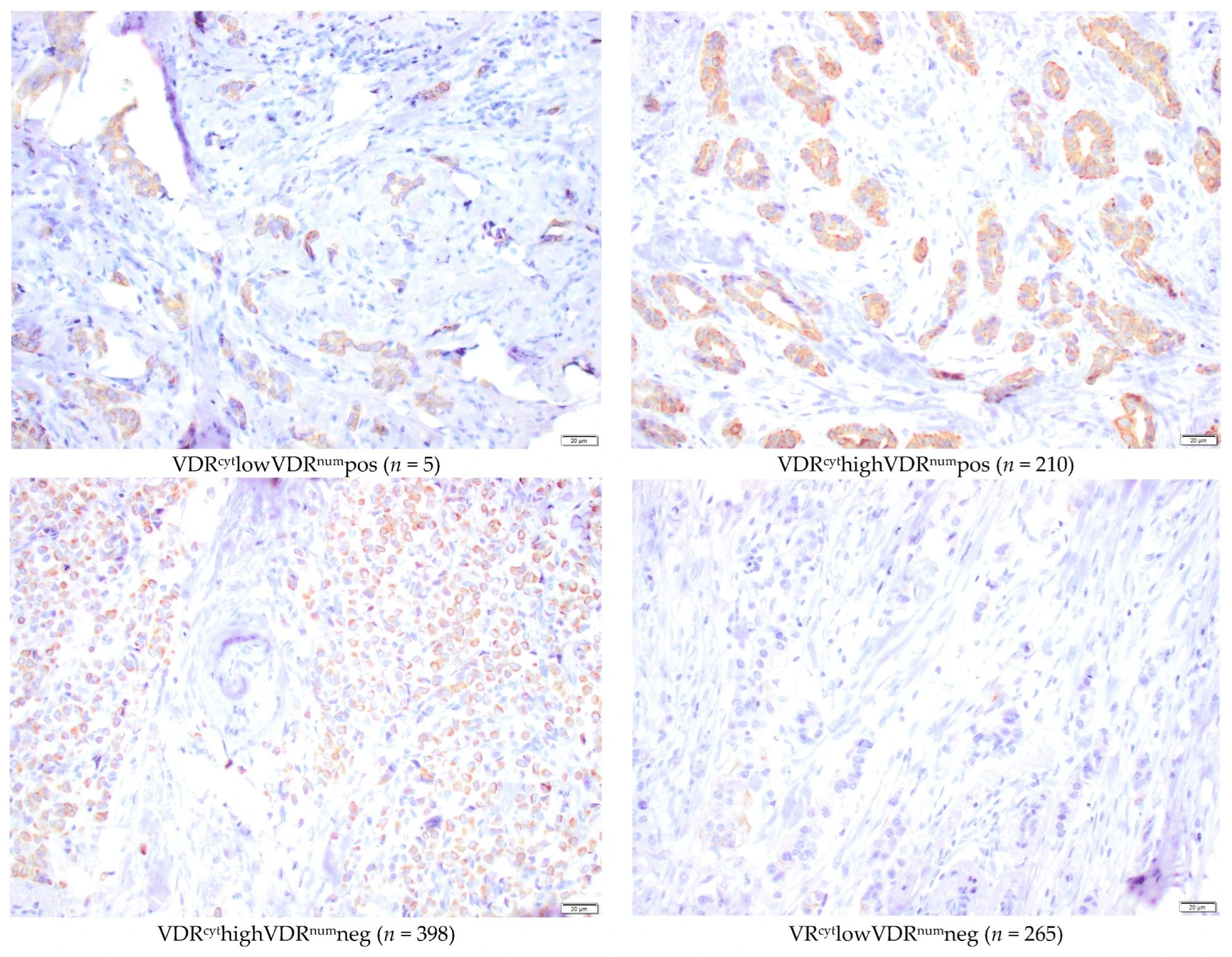 Microscopic representative images of immunohistochemical staining intensities of nuclear membrane and cytoplasmic VDR (40×) in the TMA. Bar represents 20 µm.