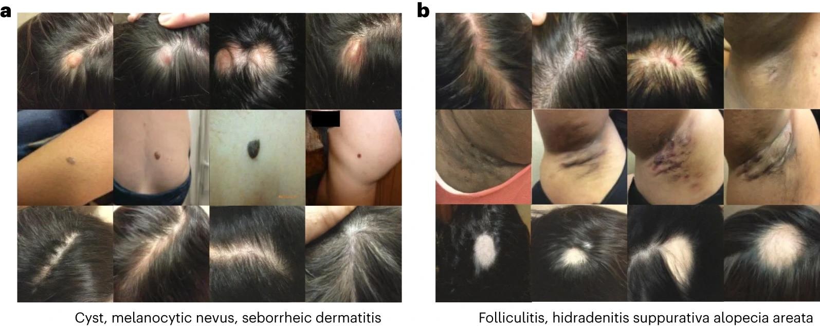 Generated images in the dermatology setting. Each row of images corresponds to a different condition. a, Generated images for cyst, melanocytic nevus and seborrheic dermatitis. b, Generated images for folliculitis, hidradenitis and alopecia areata.
