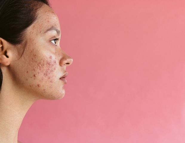 Antioxidant-rich diets linked to better life quality in young women with acne