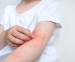 Study investigates the potential effects of neonatal vitamin D on eczema up to adulthood