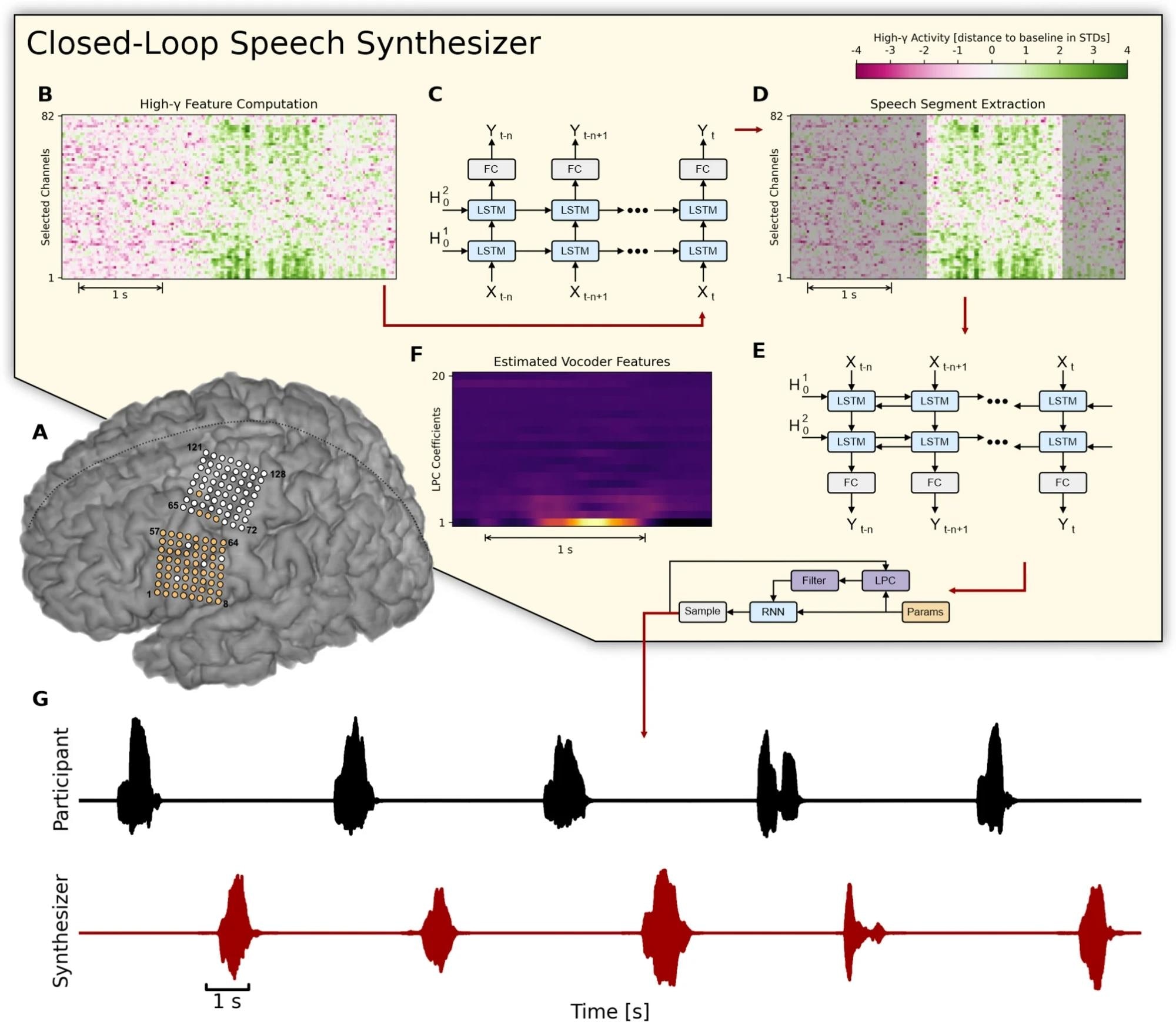 Overview of the closed-loop speech synthesizer. (A) Neural activity is acquired from a subset of 64 electrodes (highlighted in orange) from two 8 × 8 ECoG electrode arrays covering sensorimotor areas for face and tongue, and for upper limb regions. (B) The closed-loop speech synthesizer extracts high-gamma features to reveal speech-related neural correlates of attempted speech production and propagates each frame to a neural voice activity detection (nVAD) model (C) that identifies and extracts speech segments (D). When the participant finishes speaking a word, the nVAD model forwards the high-gamma activity of the whole extracted sequence to a bidirectional decoding model (E) which estimates acoustic features (F) that can be transformed into an acoustic speech signal. (G) The synthesized speech is played back as acoustic feedback.