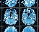 Study finds new mechanism underlying epileptic seizures